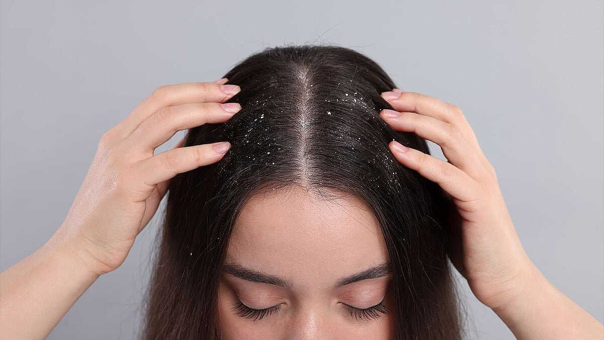 Excess oil, not dryness, causes dandruff: Here's how to control dandruff in winter