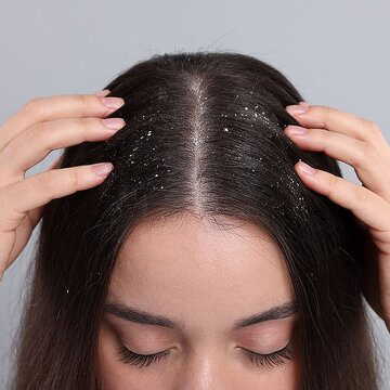 Excess oil, not dryness, causes dandruff: Here's how to control dandruff in winter