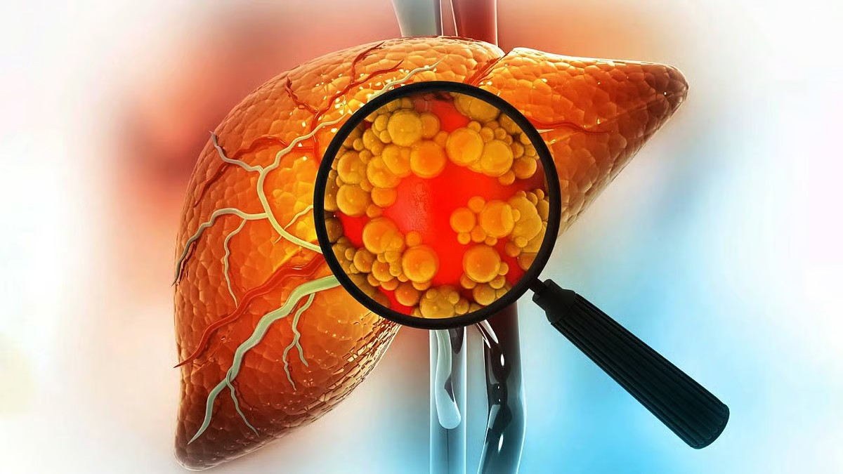 Always tired? It could be a sign of fatty liver from B12 deficiency