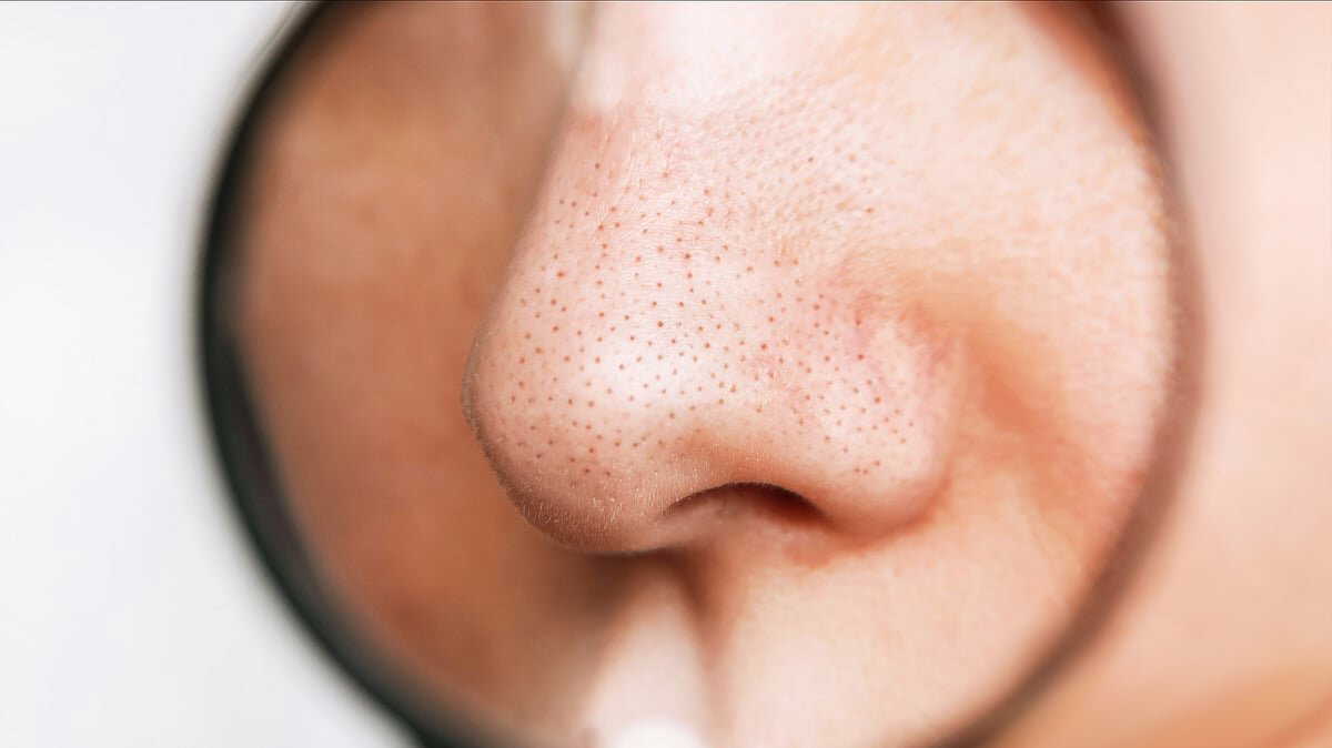 No nose strips needed: Try these 3 home remedies to remove blackheads