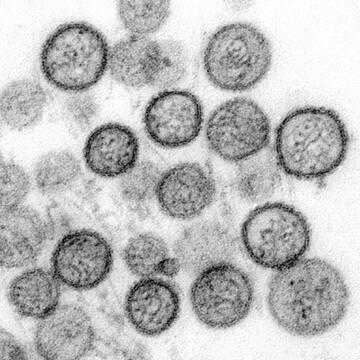What is Hantavirus? How does it spread? How to prevent it? Virus linked to three cruise deaths