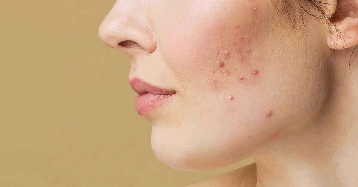 Acne won’t go away? Hormonal imbalance might be the hidden reason