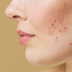 Acne won’t go away? Hormonal imbalance might be the hidden reason