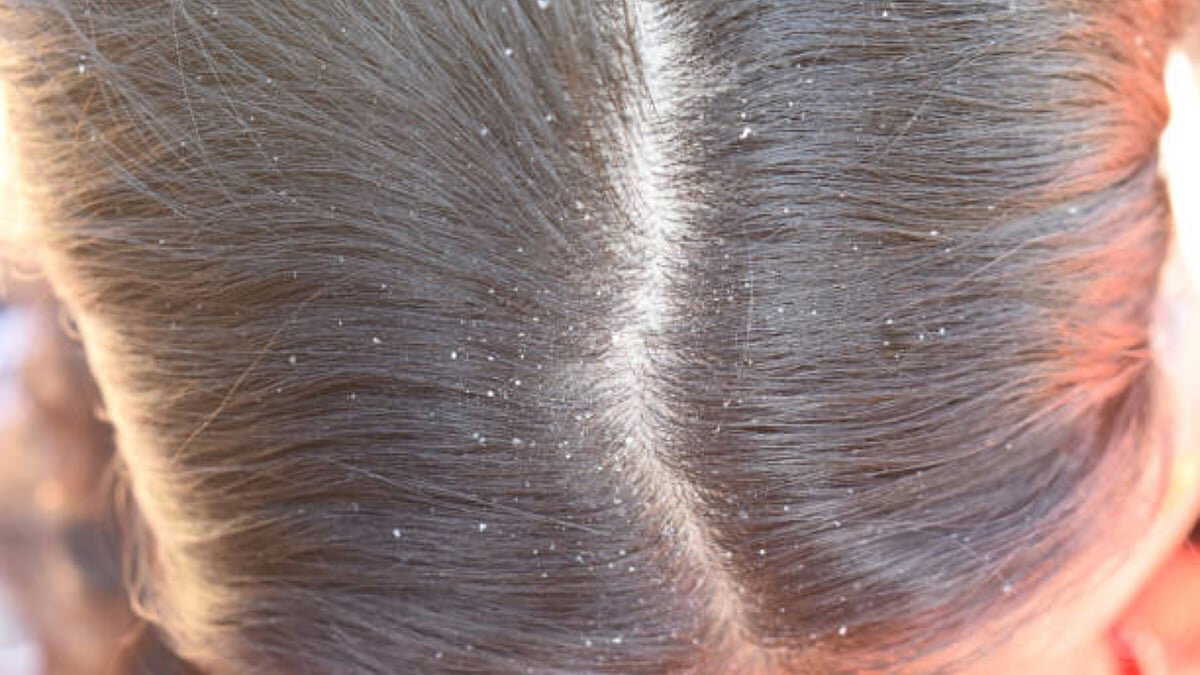 Say goodbye to dandruff in 48 hours with THIS oil and anti-dandruff shampoo combo