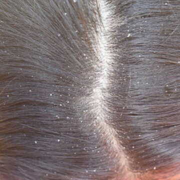 Say goodbye to dandruff in 48 hours with THIS oil and anti-dandruff shampoo combo
