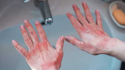 Cold water turning your hands red and itchy in winter? These simple home remedies can help