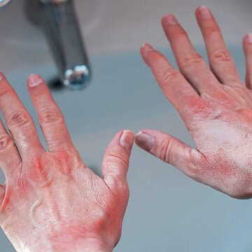 Cold water turning your hands red and itchy in winter? These simple home remedies can help