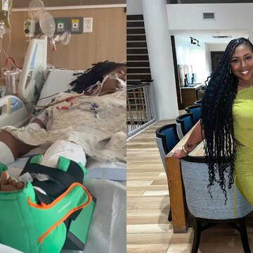 ‘Heart rate was stuck between 140-160 for days', Women's skin peels 'like a snake' after a venomous spider bite| watch