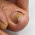 Are your nails warning you about your health? Signs that may indicate disease