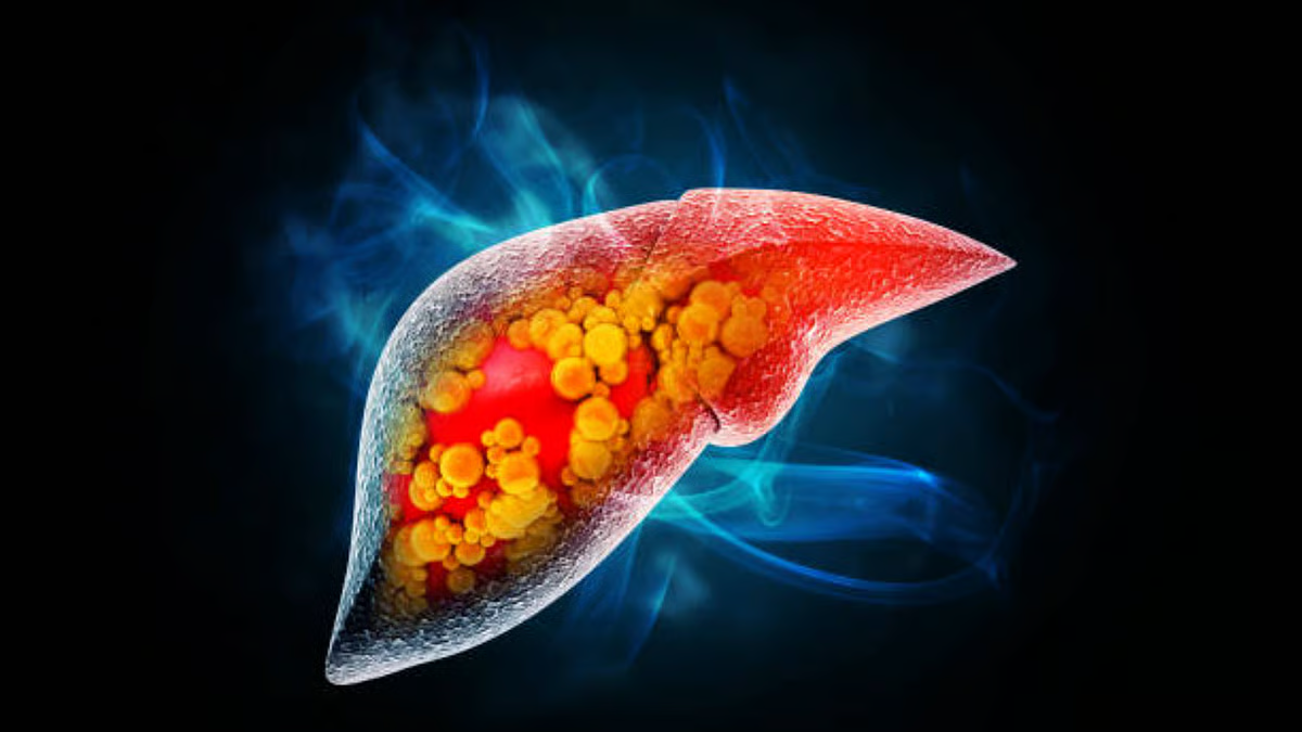 Struggling with fatty liver? These everyday foods can help reverse the damage