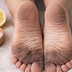 Struggling with dark heels? Try these simple home remedies to remove stains