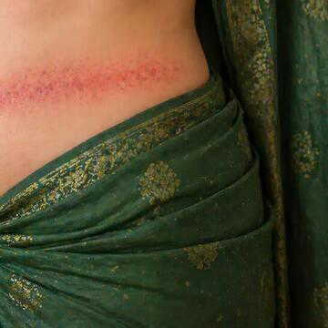 What is ‘saree cancer’? Why this little-known risk deserves attention