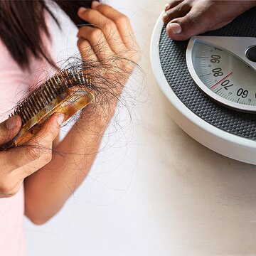 Hair fall after weight loss? Doctors say this common condition may be the reason