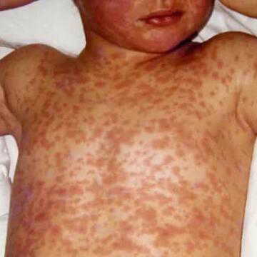 Bangladesh measles crisis deepens as child deaths climb amid vaccination gaps