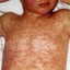 Bangladesh measles crisis deepens as child deaths climb amid vaccination gaps