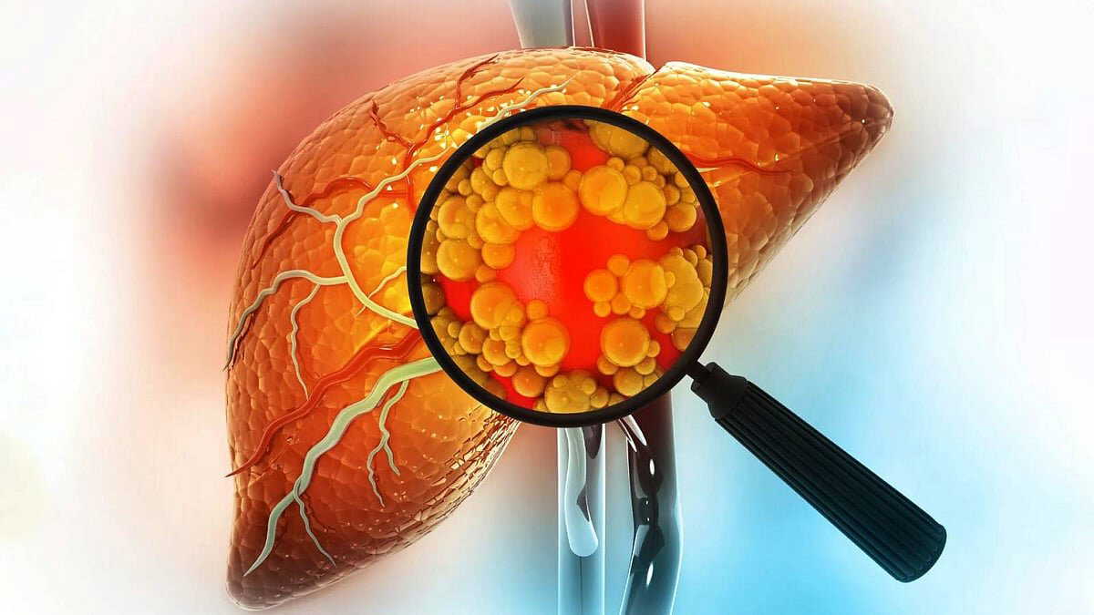 Want to keep fatty liver problems under control? Practice these 3 yoga asanas daily