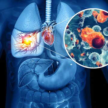 कुपोषण से बढ़ता है टीबी का खतरा, सही डाइट से मिलेगी राहत