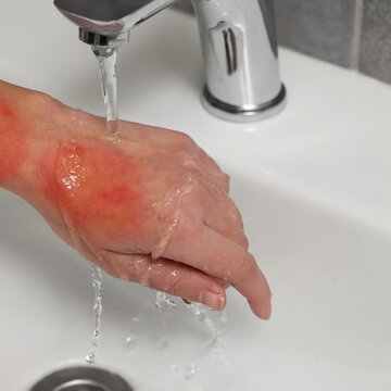 क्या करें अगर दिवाली की रात को पटाखों फोड़ते समय जल जाएं आप या बच्चे?