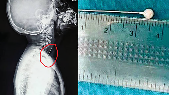 खांसी से बेदम हो रही बच्ची के गले में फंसा पिन, मेडिकल कॉलेज के डॉक्टरों ने बाहर निकालकर दी नई जिन्दगी