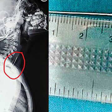 खांसी से बेदम हो रही बच्ची के गले में फंसा पिन, मेडिकल कॉलेज के डॉक्टरों ने बाहर निकालकर दी नई जिन्दगी