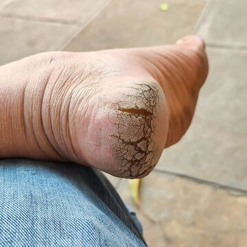 मौसम बदलते ही फटने लगी हैं एड़ियां? कैसे करेंगी फटी एड़ियों की देखभाल?