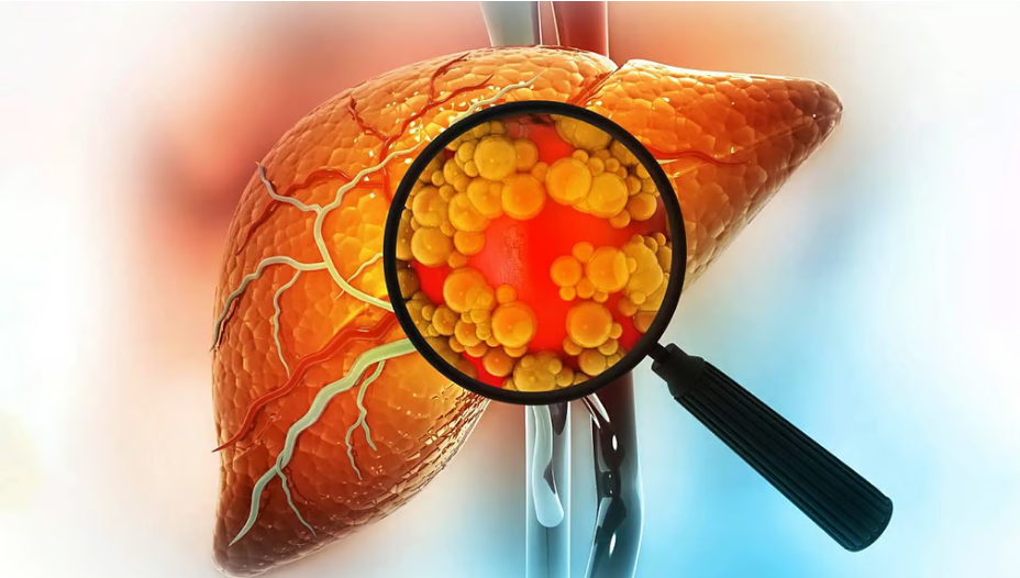 फैटी लिवर से परेशान हैं? रोज करें ये 3 योगासन, मिलेगा जबरदस्त फायदा