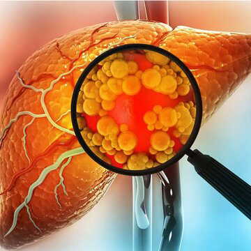 फैटी लिवर से परेशान हैं? रोज करें ये 3 योगासन, मिलेगा जबरदस्त फायदा