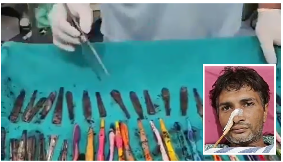 उत्तर प्रदेश के युवक को चम्मच-टूथब्रश-पेन पानी के साथ निगलने की लत