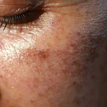 गर्मियों में महिलाओं की त्वचा पर दिखते हैं दाग-धब्बे, क्या हॉर्मोनल बदलाव है इसका मुख्य कारण