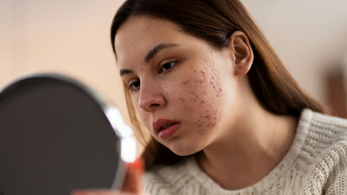 माहवारी के समय मुंहासों से भर जाता है चेहरा? क्यों होता है ऐसा और क्या है उपाय?