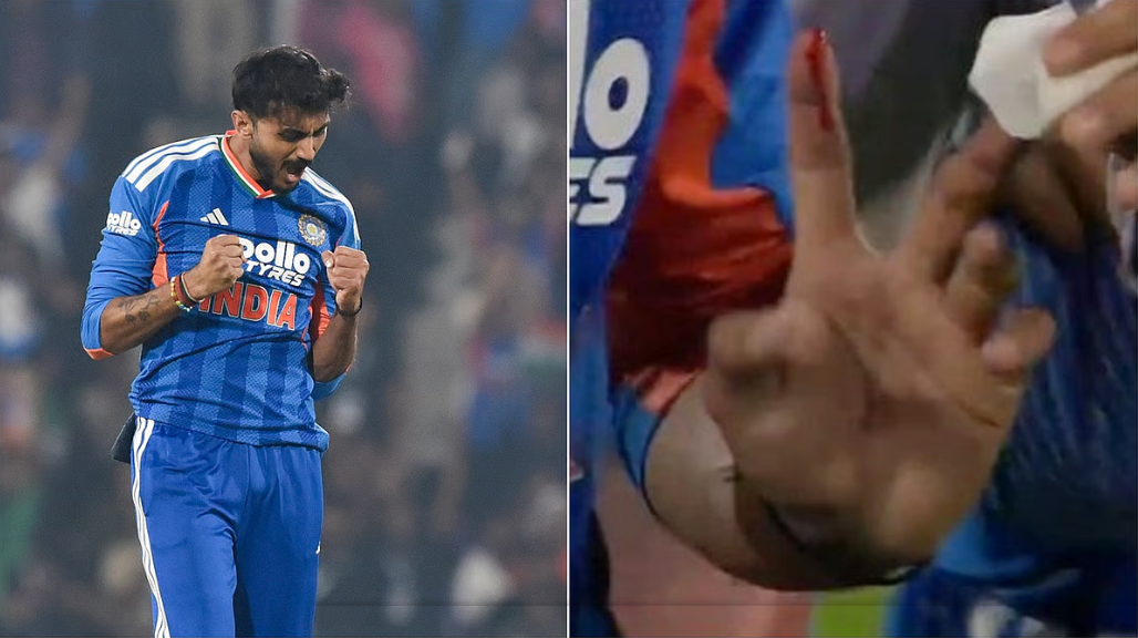 फील्डिंग के दौरान अक्षर की उंगली में फ्रैक्चर, विश्व कप से पहले बढ़ी चिंता