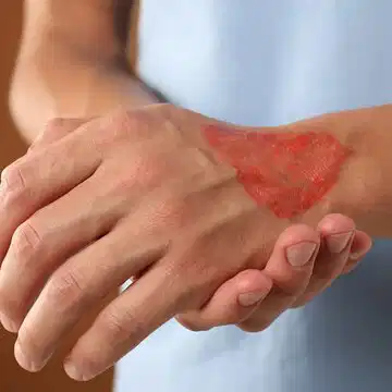 जलने पर बर्फ नहीं, इस गलती से कितना बड़ा नुकसान हो सकता है, जानते हैं?