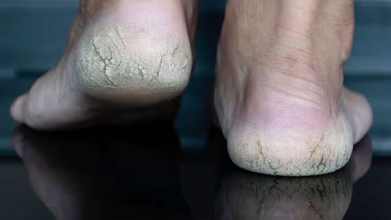 सर्दियों में फटी एड़ियां कर रही हैं परेशान तो जरूर आजमाएं शहनाज हुसैन के ये घरेलू नुस्खे